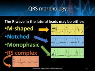 QRS morphology
The R wave in the lateral leads may be either:
•M-shaped
•Notched
•Monophasic
•RS complex
PowerPlugs Templates for PowerPoint Preview 15
 