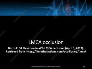 LMCA occlusion
Burns E. ST Elevation in aVR-LMCA occlusion (April 3, 2017).
Retrieved from https://lifeinthefastlane.com/ecg-library/lmca/
PowerPlugs Templates for PowerPoint Preview 17
 