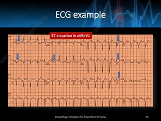 ECG example
PowerPlugs Templates for PowerPoint Preview 20
ST-elevation in aVR>V1
 