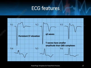 ECG features
PowerPlugs Templates for PowerPoint Preview 27
Persistent ST elevation
qS waves
T-waves have smaller
amplitude than QRS complexes
 