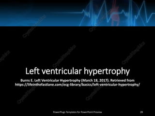 Left ventricular hypertrophy
Burns E. Left Ventricular Hypertrophy (March 18, 2017). Retrieved from
https://lifeinthefastlane.com/ecg-library/basics/left-ventricular-hypertrophy/
PowerPlugs Templates for PowerPoint Preview 28
 
