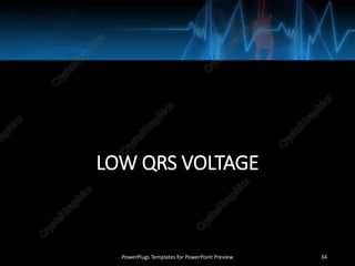 LOW QRS VOLTAGE
PowerPlugs Templates for PowerPoint Preview 34
 