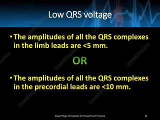 Low QRS voltage
•The amplitudes of all the QRS complexes
in the limb leads are <5 mm.
•The amplitudes of all the QRS complexes
in the precordial leads are <10 mm.
PowerPlugs Templates for PowerPoint Preview 35
 
