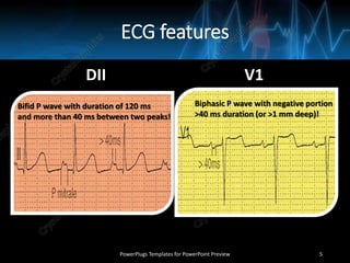 ECG features
DII V1
PowerPlugs Templates for PowerPoint Preview 5
Bifid P wave with duration of 120 ms
and more than 40 ms between two peaks!
Biphasic P wave with negative portion
>40 ms duration (or >1 mm deep)!
 