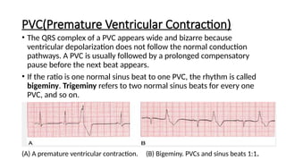 Normal Pvc Basics of ECG Interpretation and identifying the abnormal ECG | PPTX