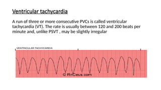 Basics of ECG Interpretation and identifying the abnormal ECG | PPTX