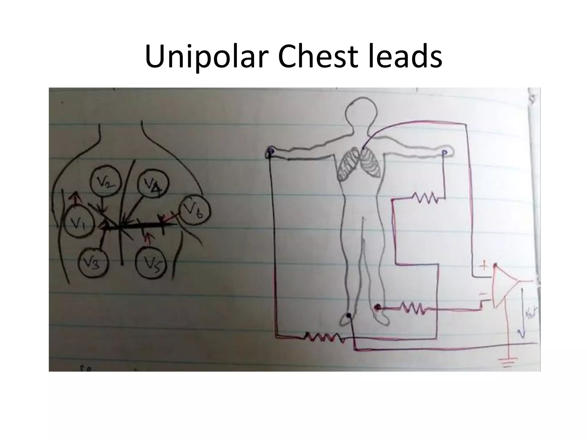 Unipolar Chest leads
 
