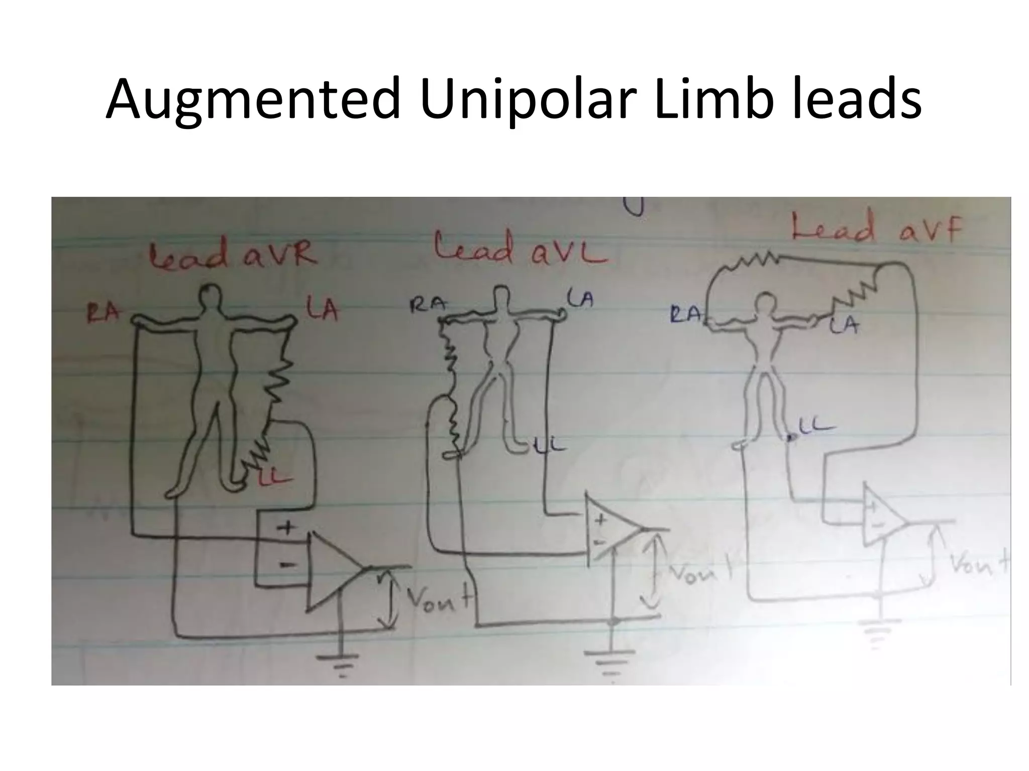 Augmented Unipolar Limb leads
 