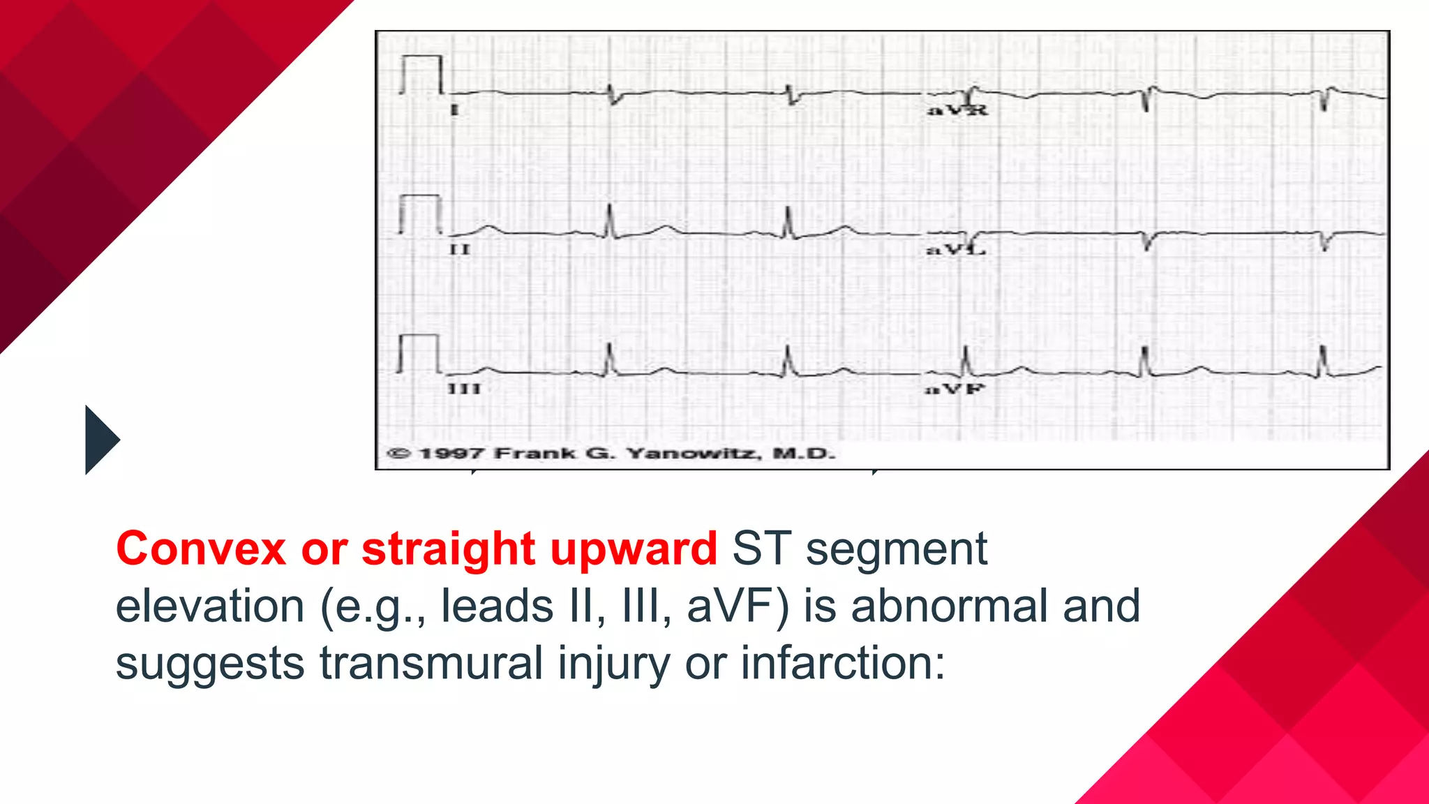 Convex or straight upward ST segment
elevation (e.g., leads II, III, aVF) is abnormal and
suggests transmural injury or infarction:
 