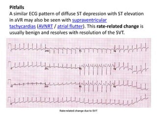 Svt Depression ECG life in the fastlane.pptx