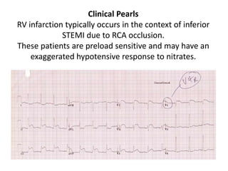 Preload Effected Rv Infarct ECG life in the fastlane.pptx
