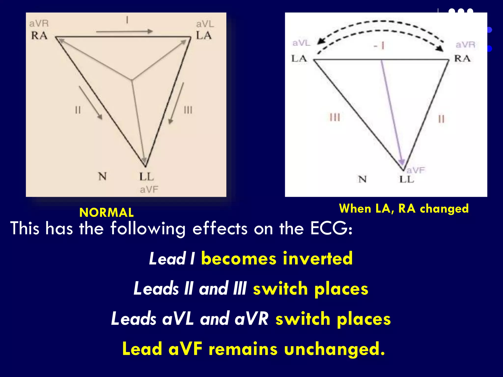This has the following effects on the ECG:
Lead I becomes inverted.
Leads II and III switch places.
Leads aVL and aVR switch places.
Lead aVF remains unchanged.
NORMAL When LA, RA changed
 