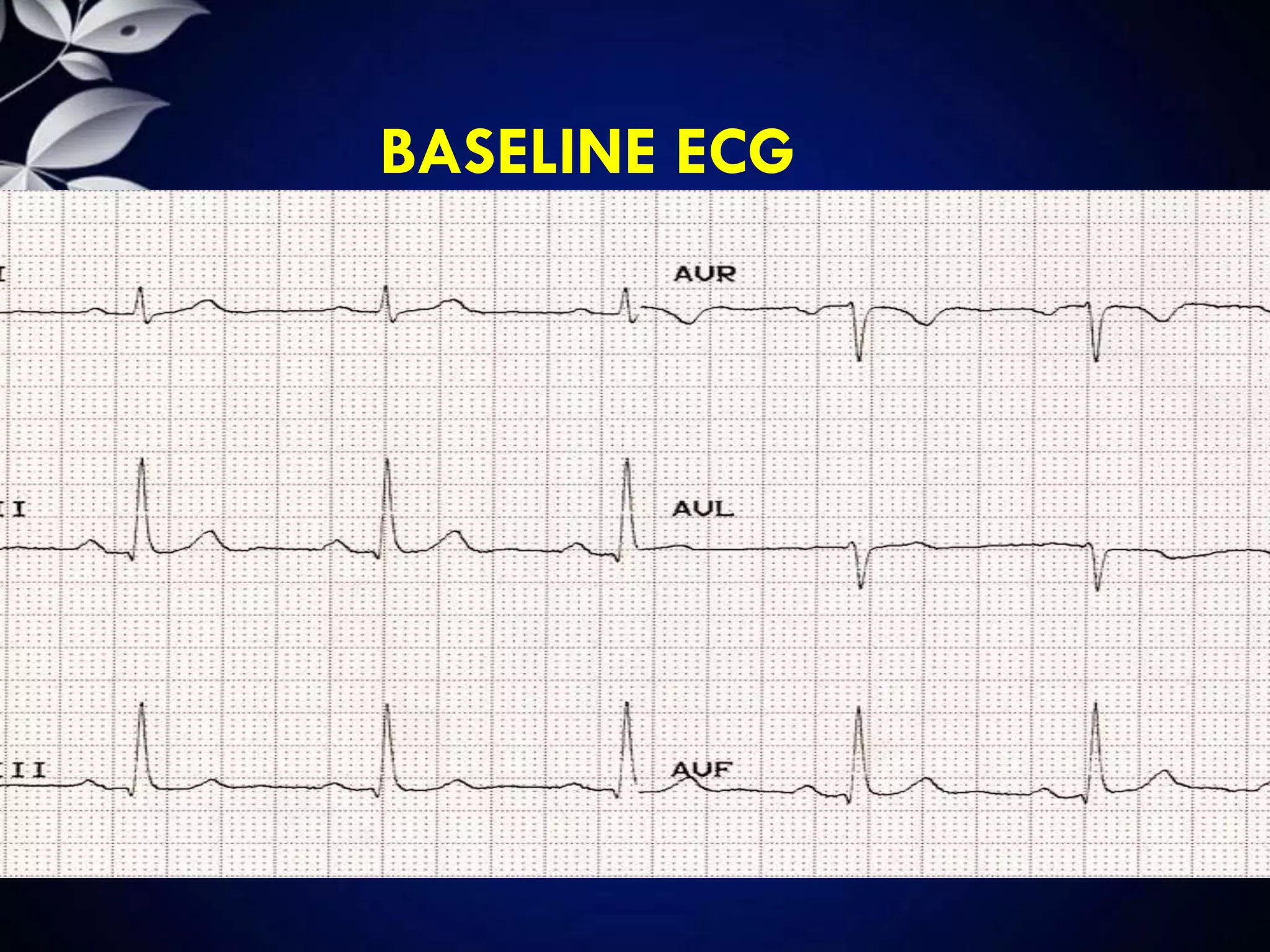 BASELINE ECG
 