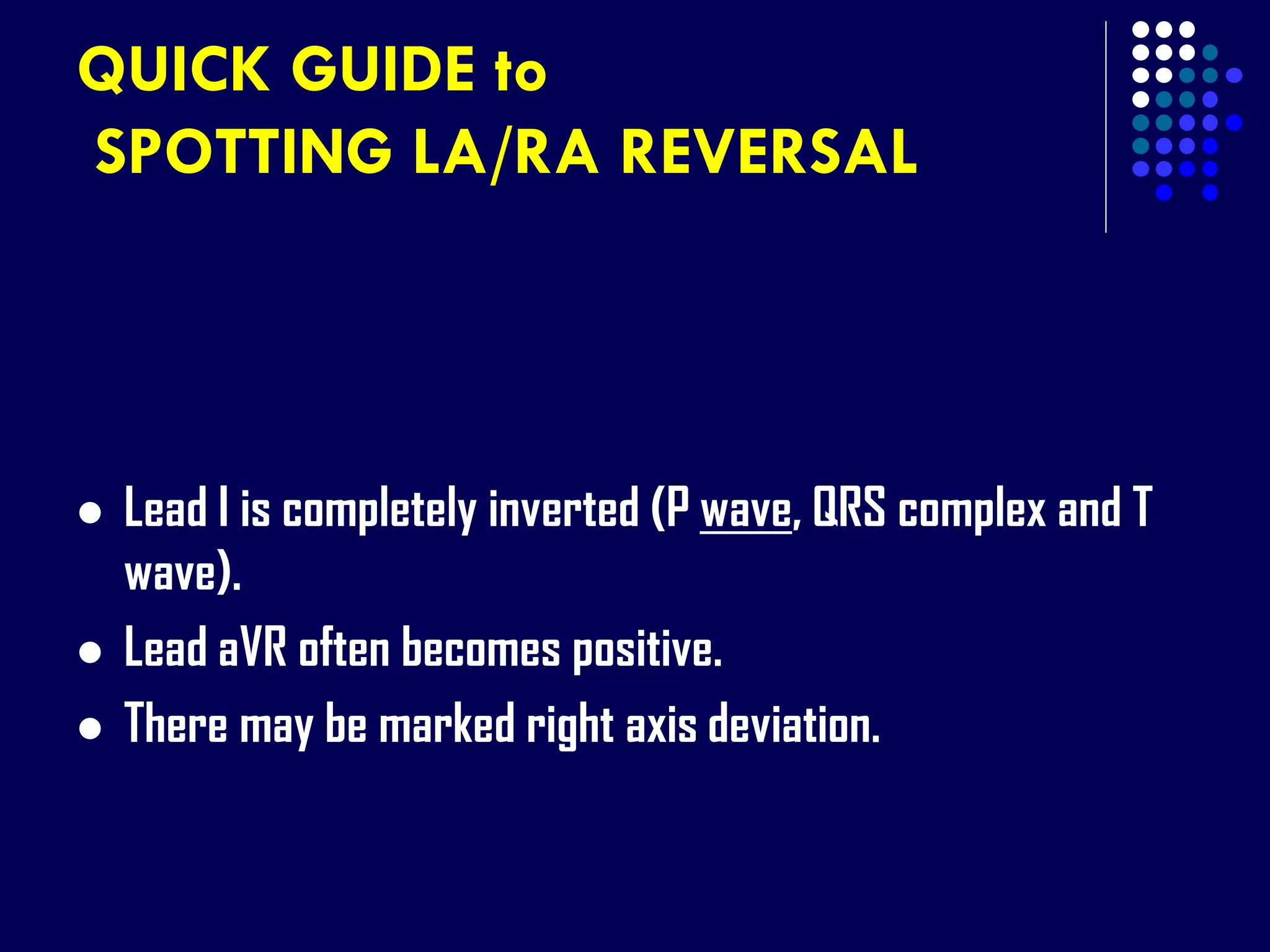 QUICK GUIDE to
SPOTTING LA/RA REVERSAL
 Lead I is completely inverted (P wave, QRS complex and T
wave).
 Lead aVR often becomes positive.
 There may be marked right axis deviation.
 
