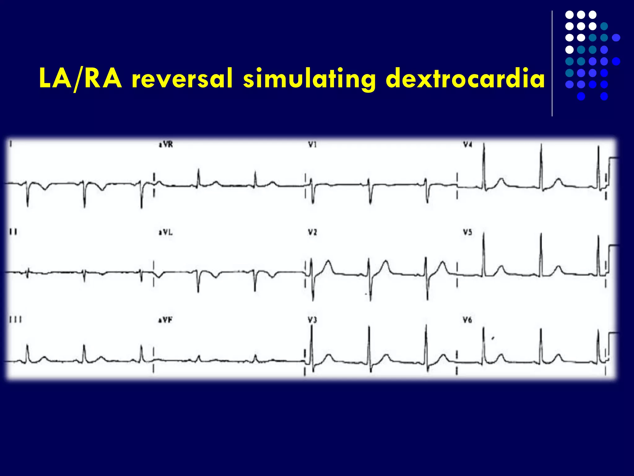 LA/RA reversal simulating dextrocardia
 