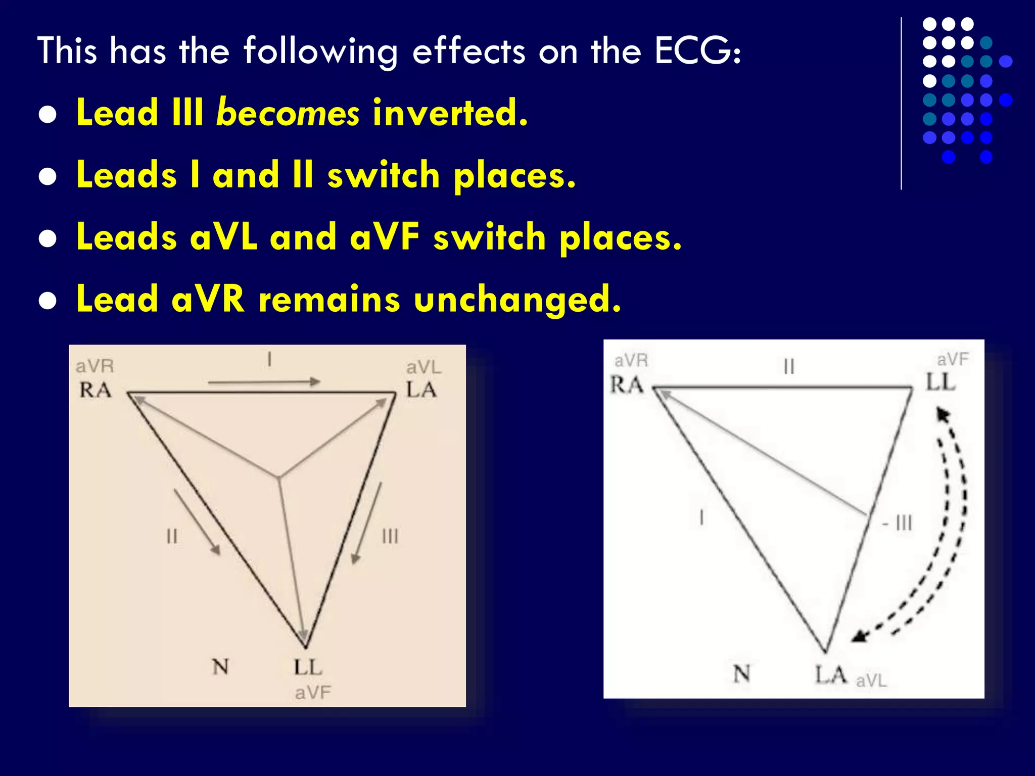 This has the following effects on the ECG:
 Lead III becomes inverted.
 Leads I and II switch places.
 Leads aVL and aVF switch places.
 Lead aVR remains unchanged.
 