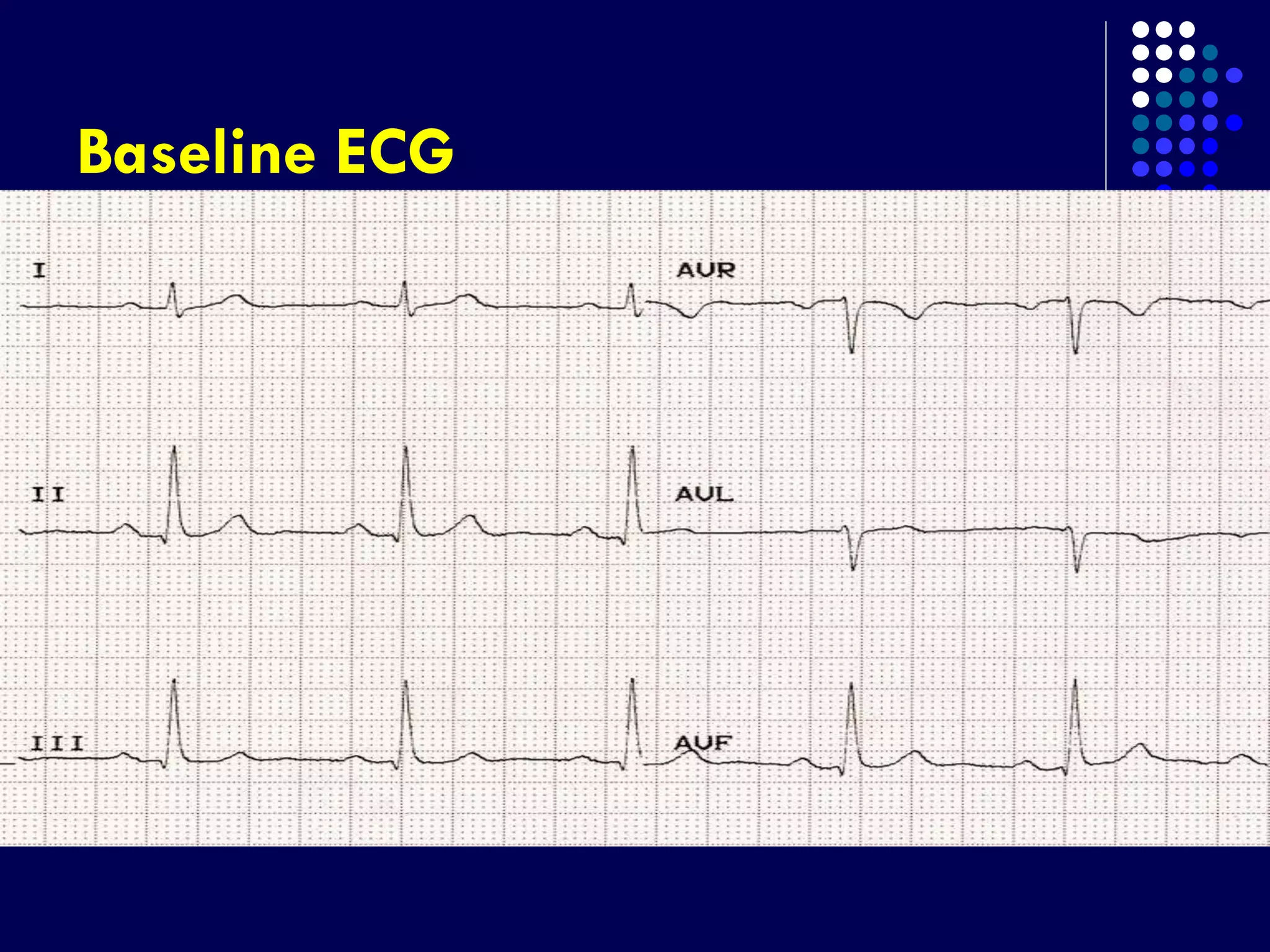 Baseline ECG
 