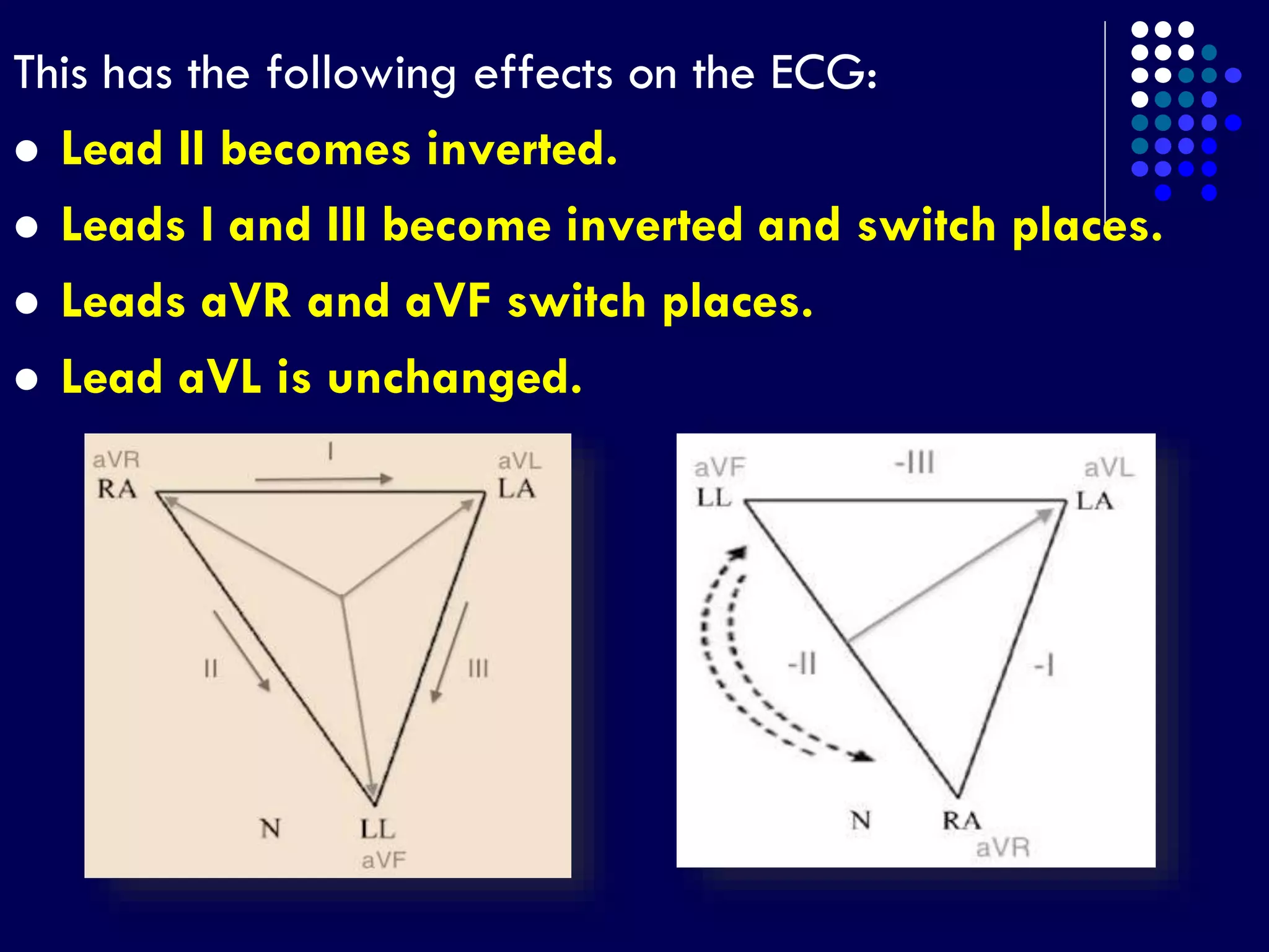 This has the following effects on the ECG:
 Lead II becomes inverted.
 Leads I and III become inverted and switch places.
 Leads aVR and aVF switch places.
 Lead aVL is unchanged.
 