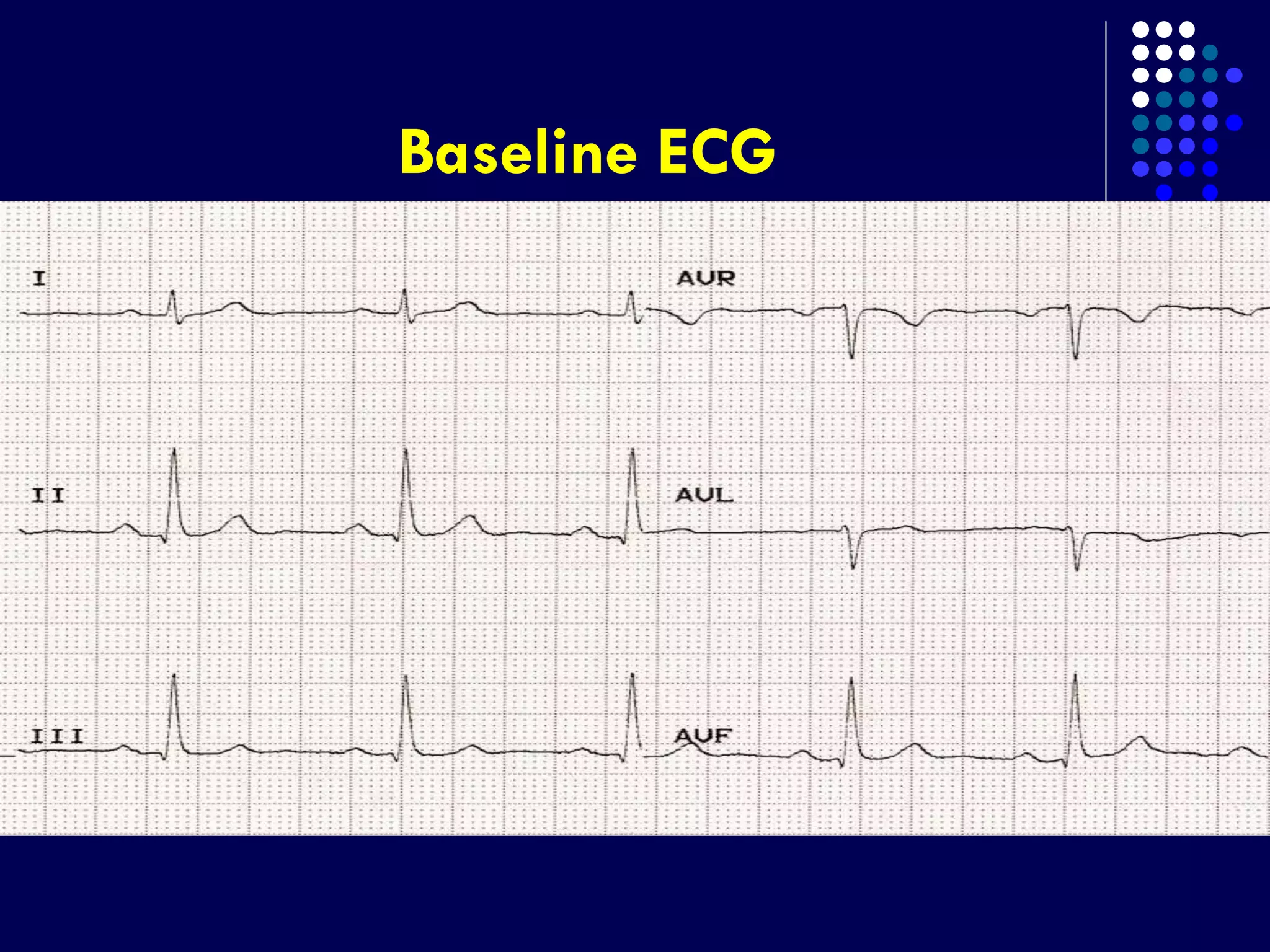 Baseline ECG
 