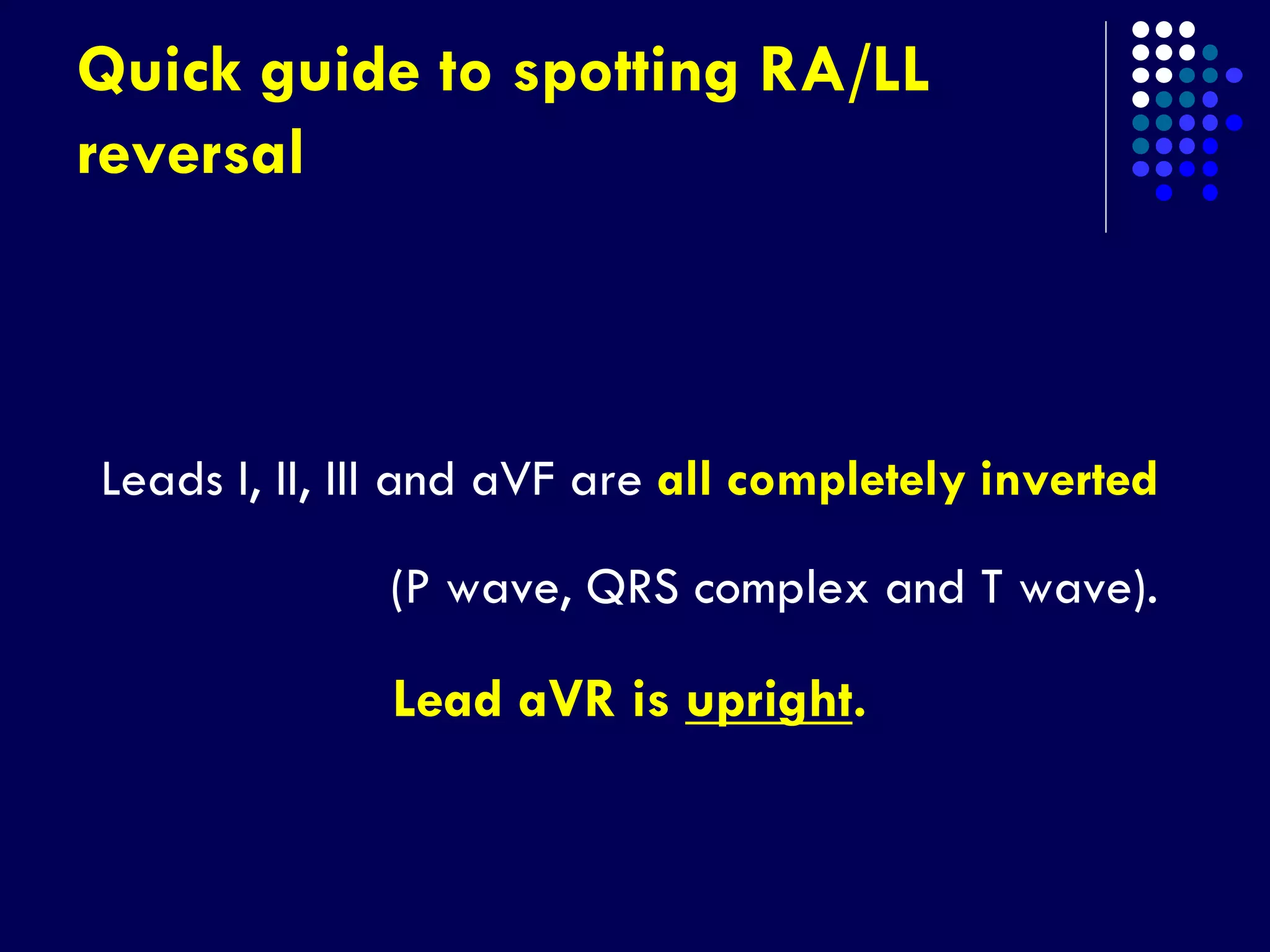 Quick guide to spotting RA/LL
reversal
Leads I, II, III and aVF are all completely inverted
(P wave, QRS complex and T wave).
Lead aVR is upright.
 