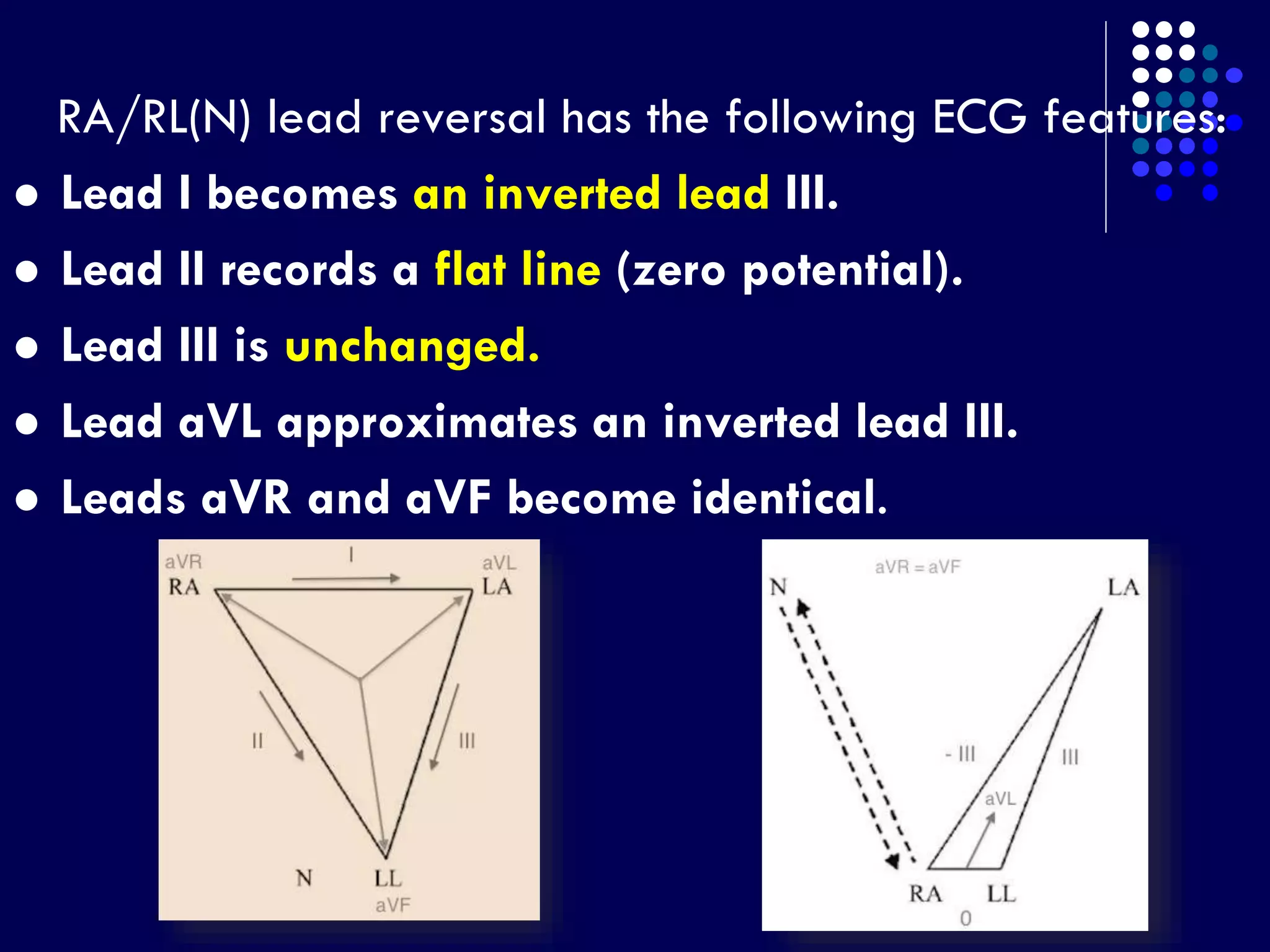 RA/RL(N) lead reversal has the following ECG features:
 Lead I becomes an inverted lead III.
 Lead II records a flat line (zero potential).
 Lead III is unchanged.
 Lead aVL approximates an inverted lead III.
 Leads aVR and aVF become identical.
 