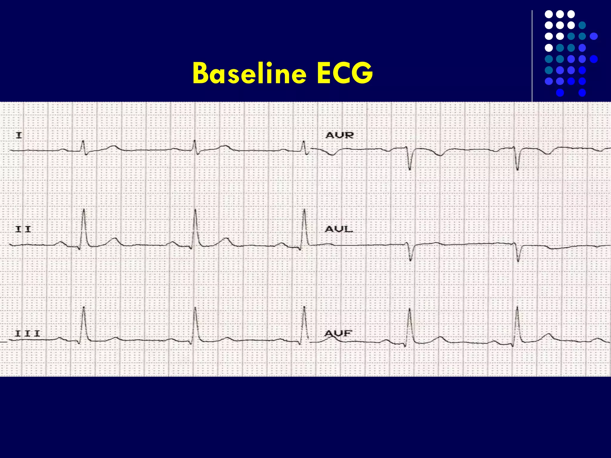 Baseline ECG
 