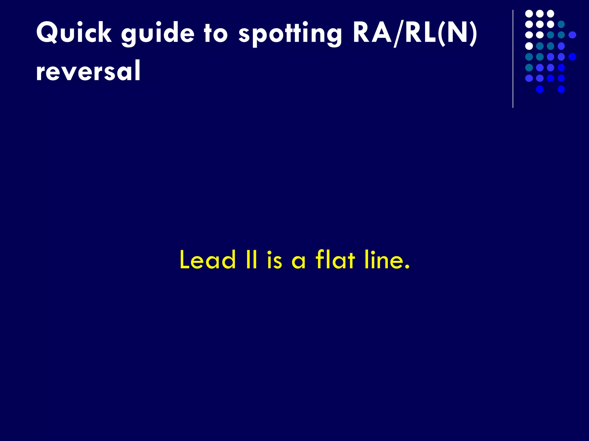 Quick guide to spotting RA/RL(N)
reversal
Lead II is a flat line.
 