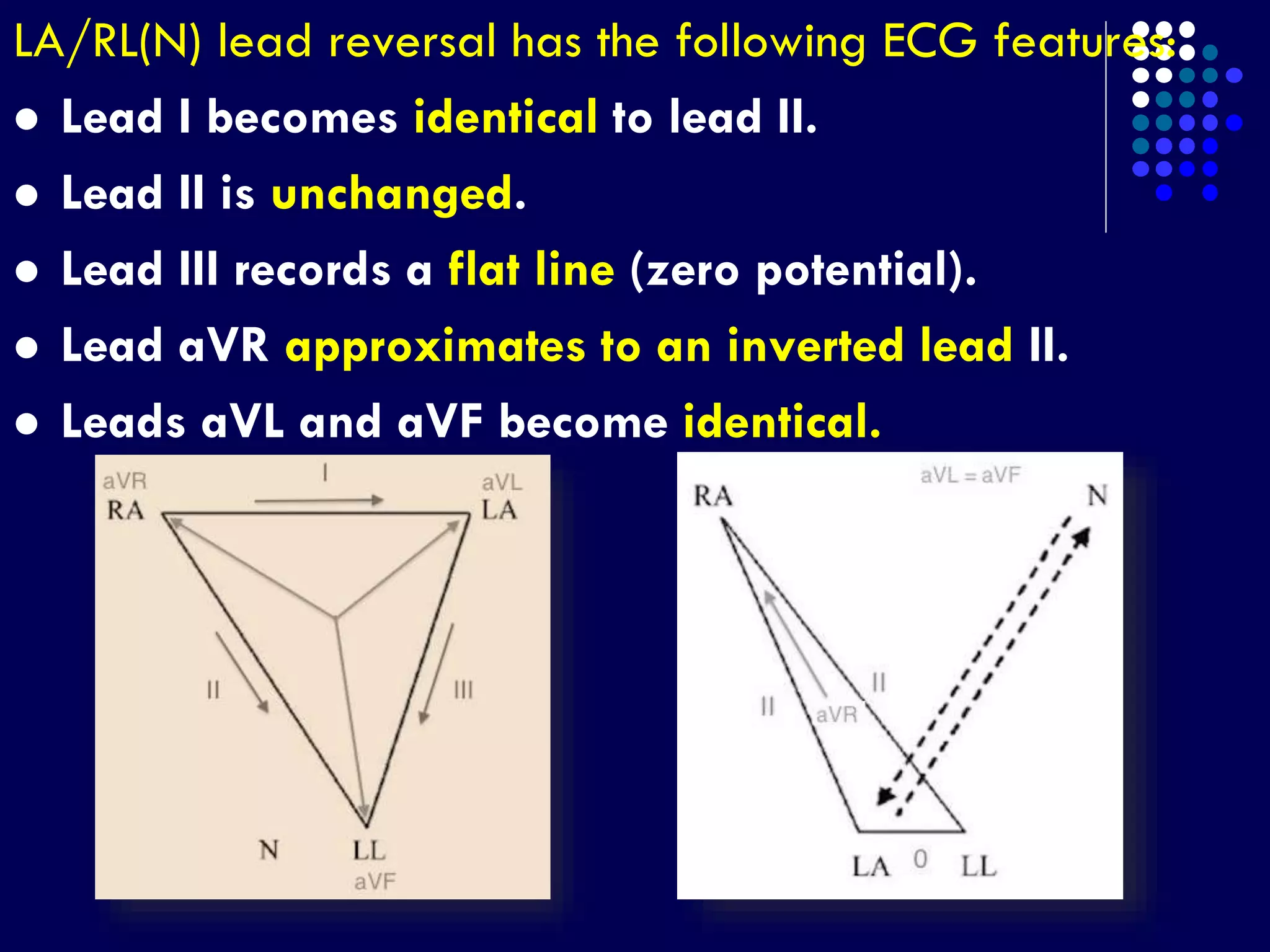 LA/RL(N) lead reversal has the following ECG features:
 Lead I becomes identical to lead II.
 Lead II is unchanged.
 Lead III records a flat line (zero potential).
 Lead aVR approximates to an inverted lead II.
 Leads aVL and aVF become identical.
 
