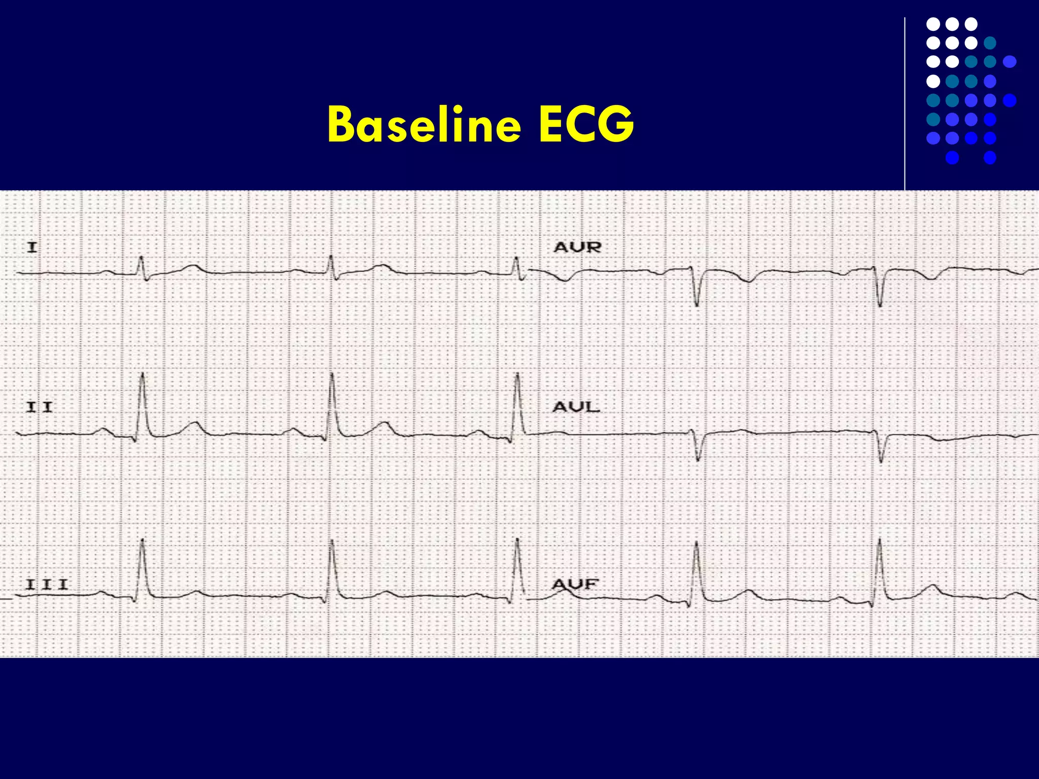 Baseline ECG
 