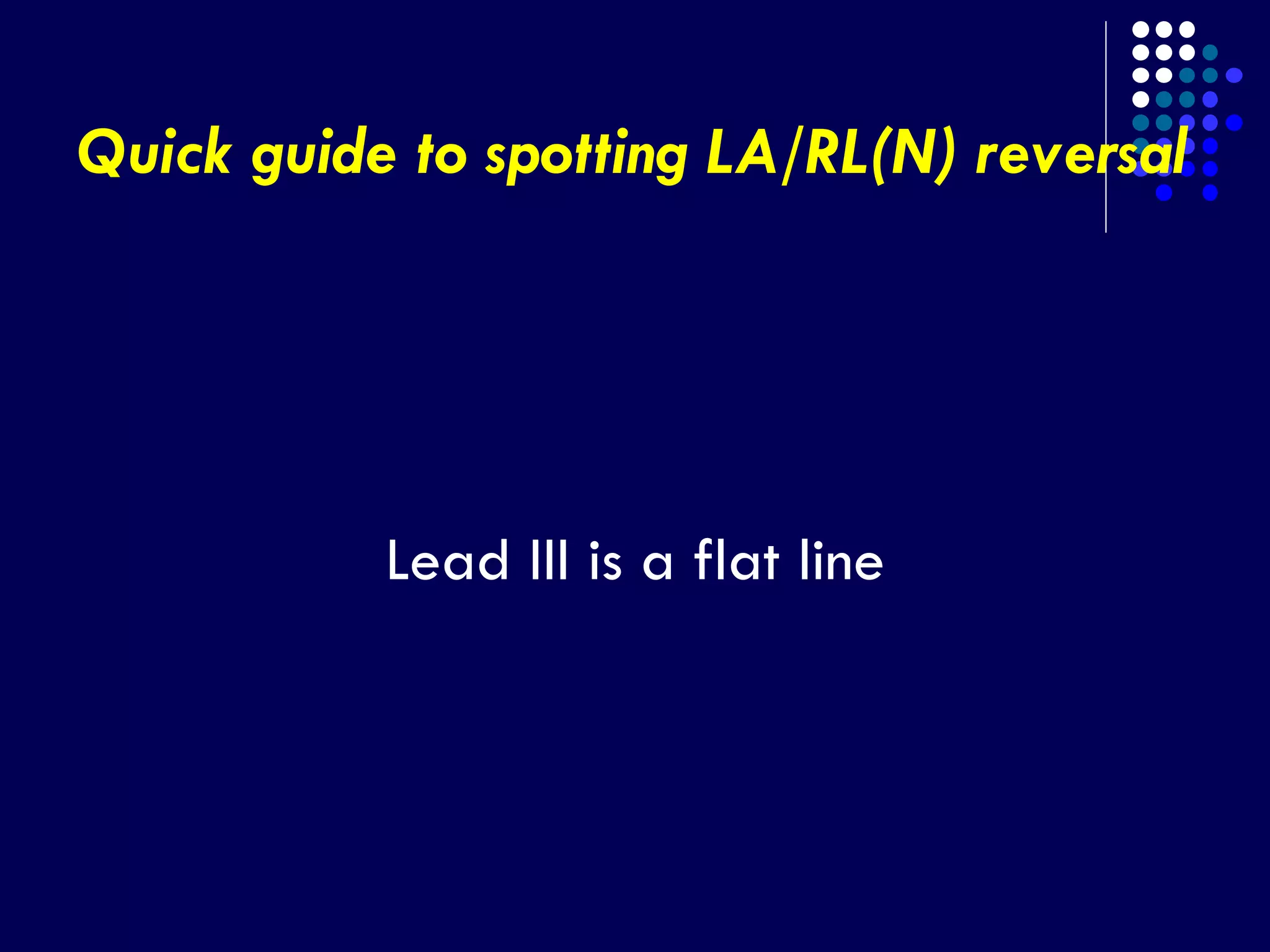 Quick guide to spotting LA/RL(N) reversal
Lead III is a flat line
 