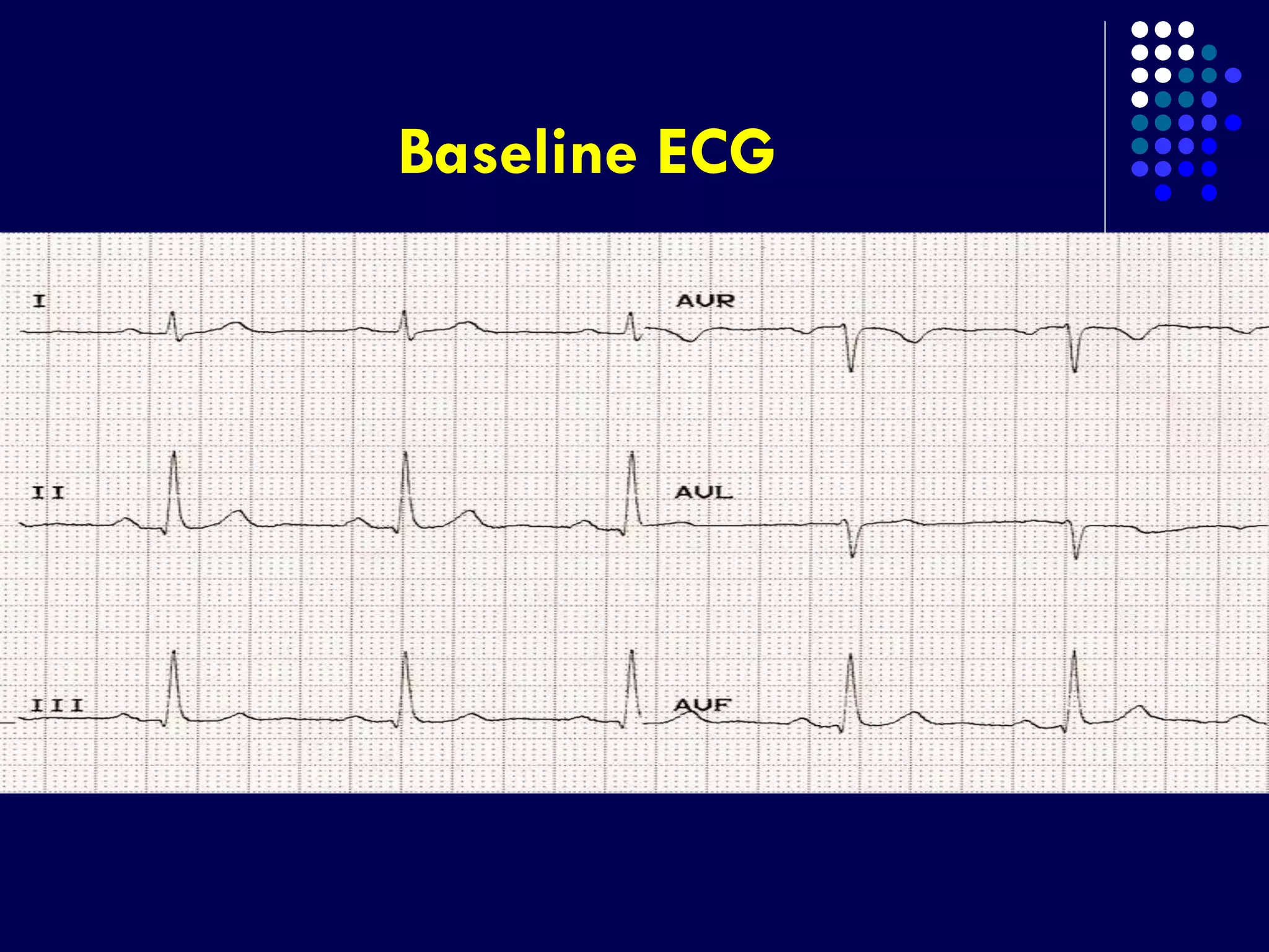 Baseline ECG
 