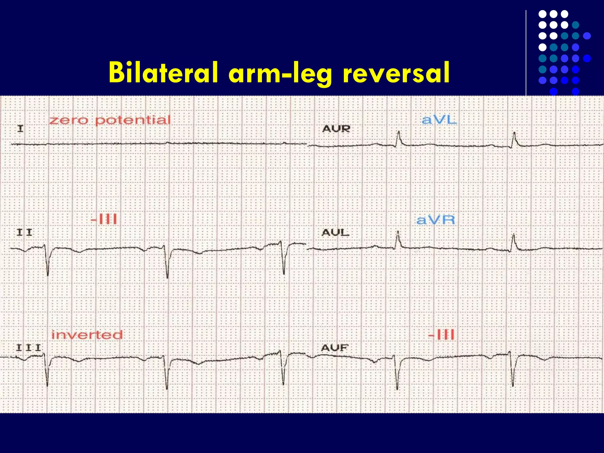 Bilateral arm-leg reversal
 