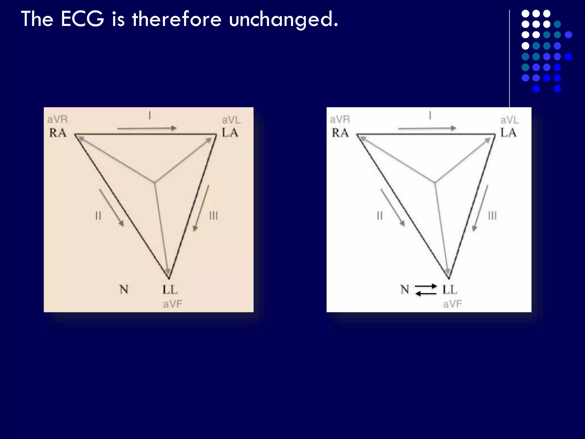 The ECG is therefore unchanged.
 