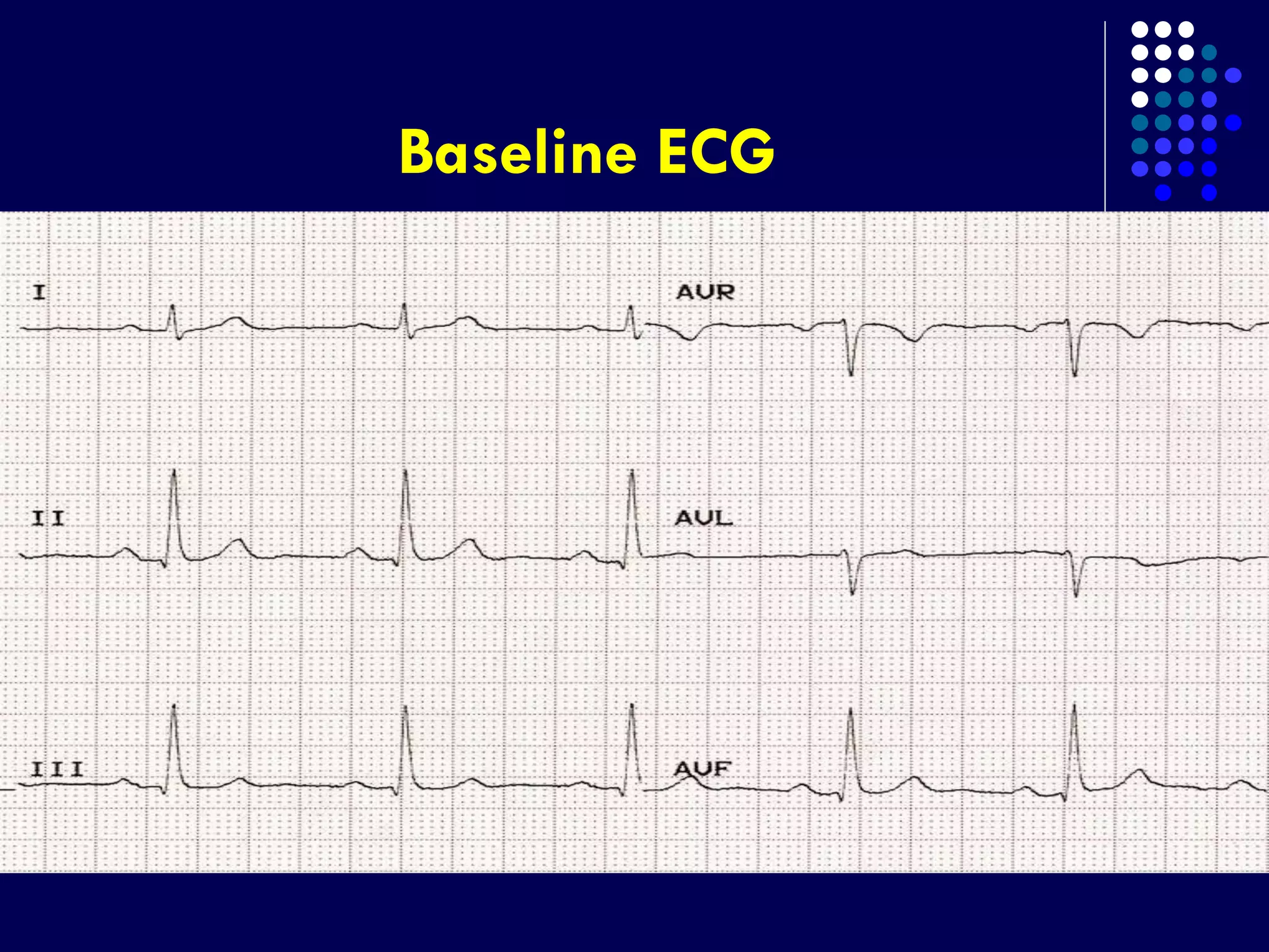 Baseline ECG
 