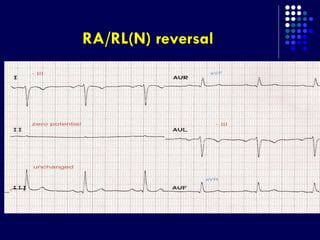 Left Rln Path ECG LIMB LEAD REVERSAL | PPTX
