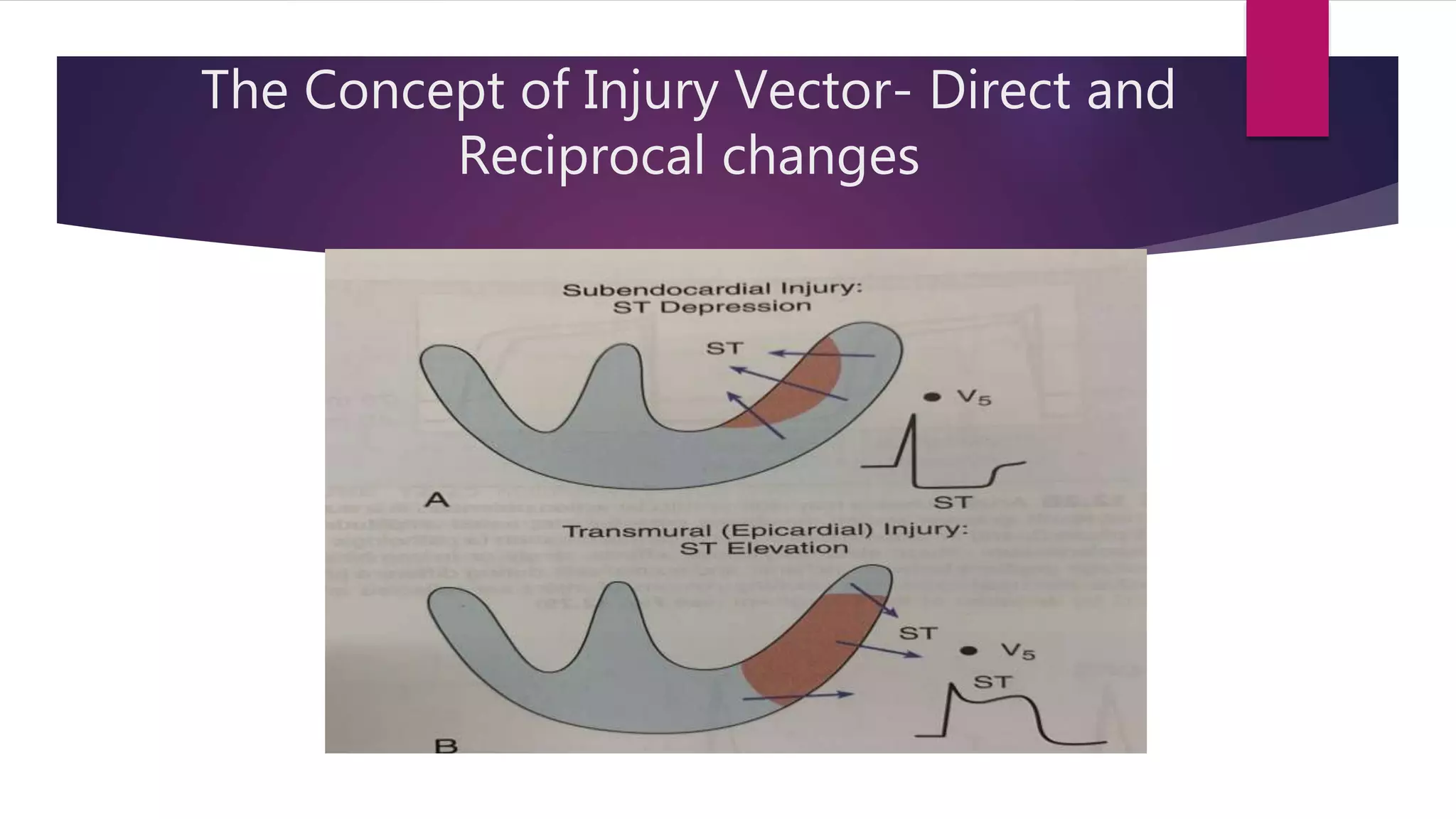 Ecg localization of myocardial infarction | PPTX