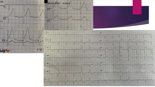 Ecg localization of myocardial infarction | PPTX