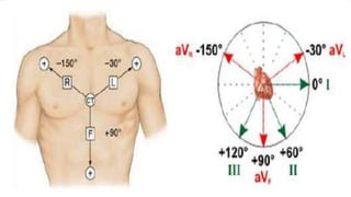 Ecg localization of myocardial infarction | PPTX
