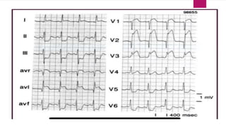 Localizing Mi Ecg localization of myocardial infarction | PPTX