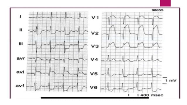 Ecg localization of myocardial infarction | PPTX | Heart and ...