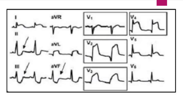 Ecg localization of myocardial infarction | PPTX | Heart and ...