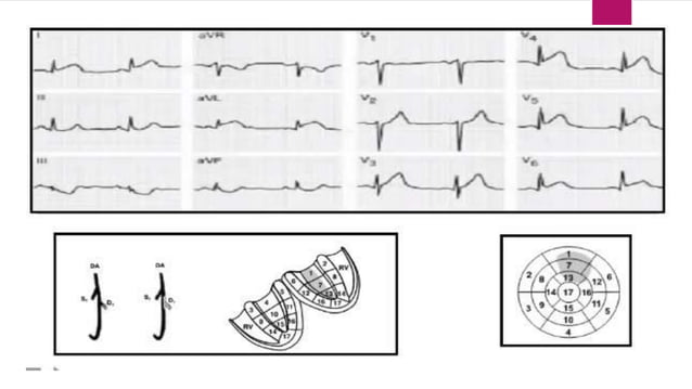 Ecg localization of myocardial infarction | PPTX | Heart and ...