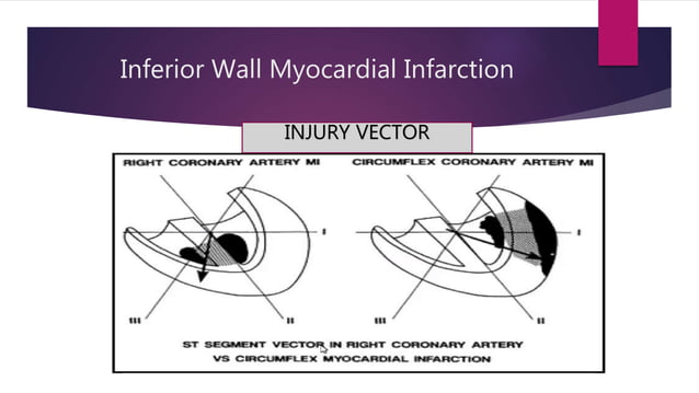 Ecg localization of myocardial infarction | PPTX | Heart and ...