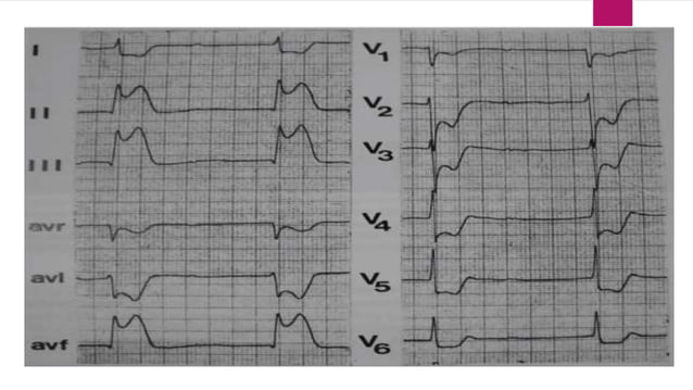 Ecg localization of myocardial infarction | PPTX | Heart and ...