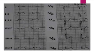 Localizing Mi Ecg localization of myocardial infarction | PPTX