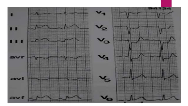 Ecg localization of myocardial infarction | PPTX | Heart and ...