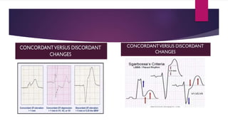Ecg localization of myocardial infarction | PPTX