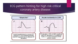 Ecg localization of myocardial infarction | PPTX
