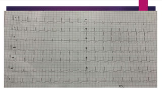 Ecg localization of myocardial infarction | PPTX