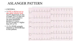 ECG LOCALIZTION OF CULPRIT VESSEL IN MI.pptx
